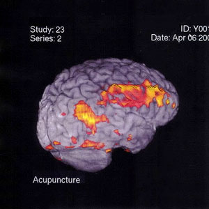 Acupuncture Brain Scan Image